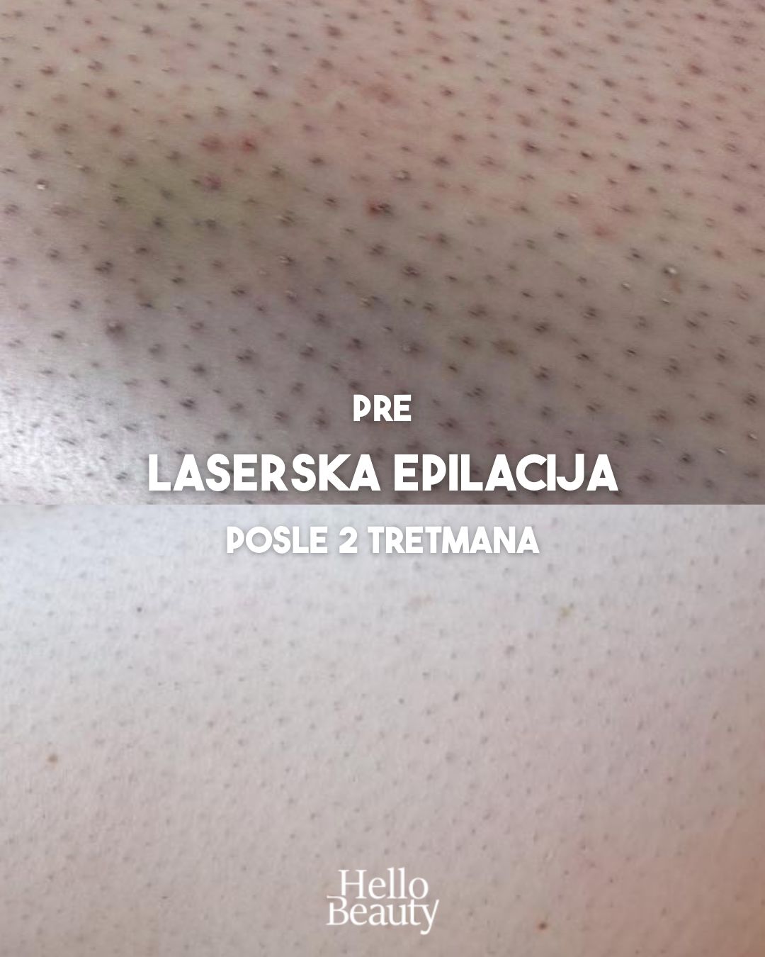 Rezultati laserske epilacije