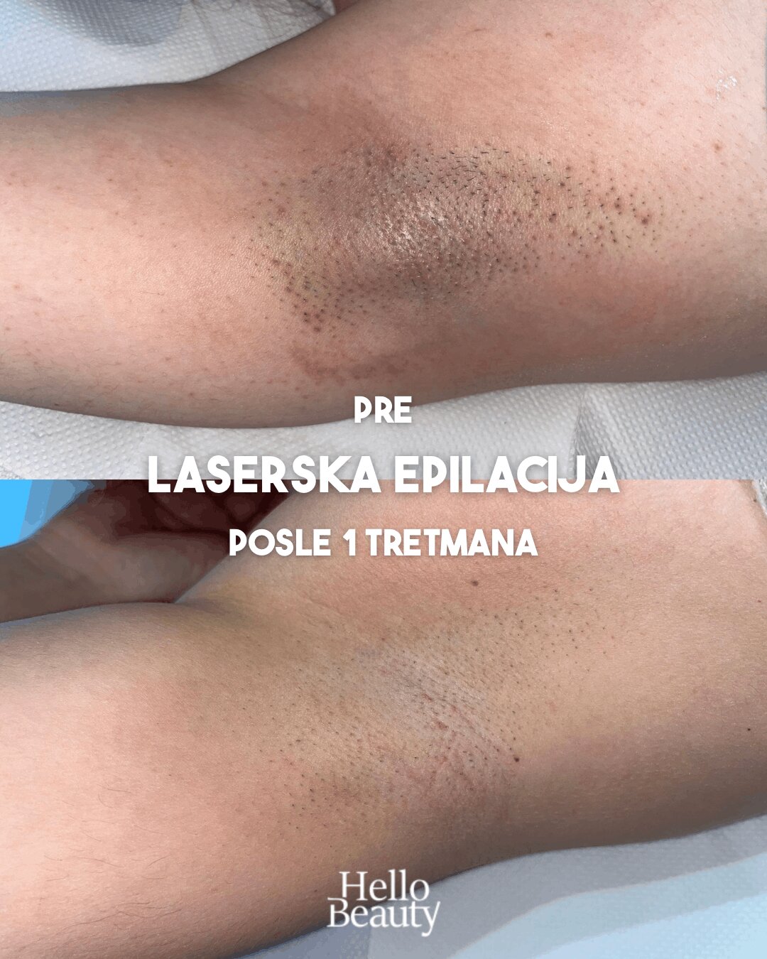 Rezultati laserske epilacije
