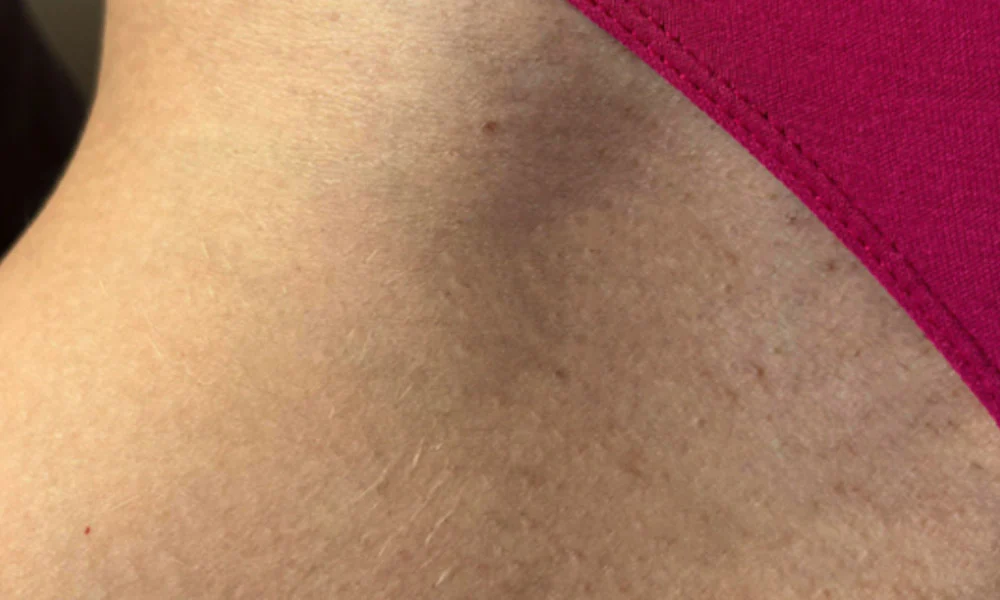 Bikini zona posle